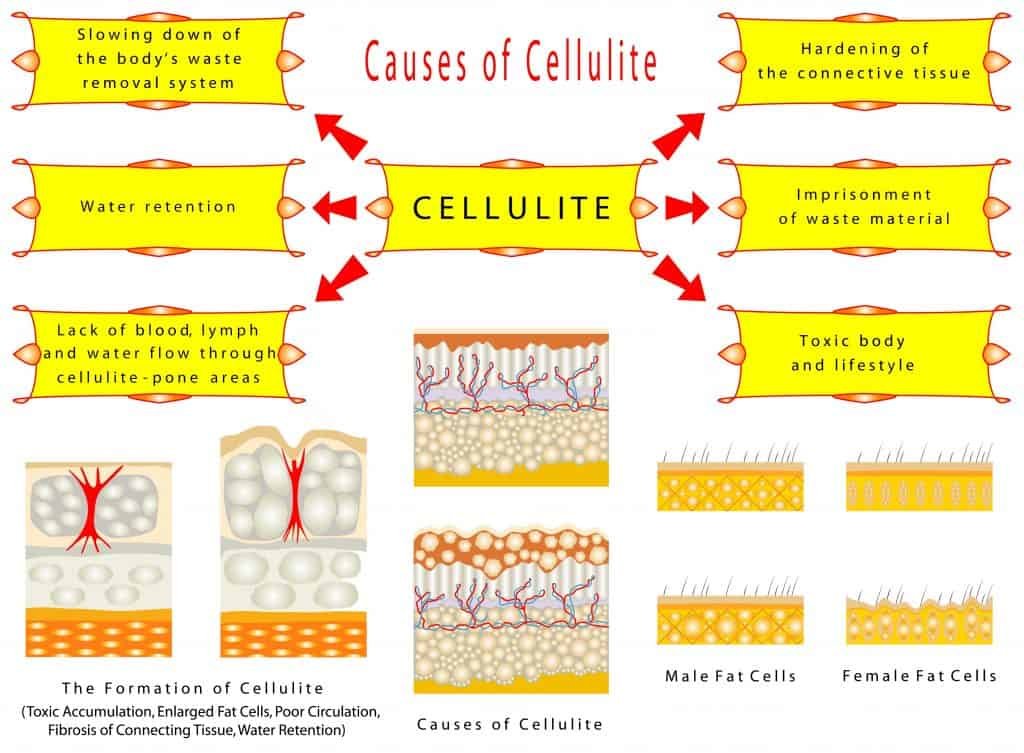 Cellulite treatment