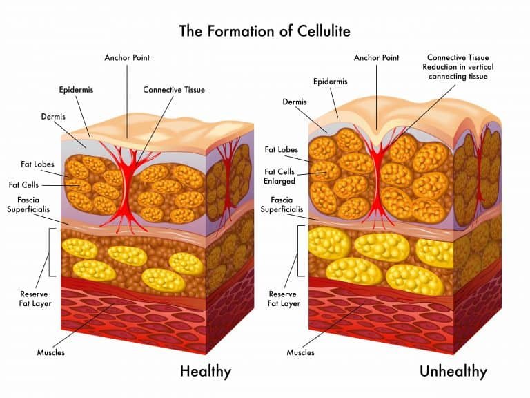 Getting rid of cellulite