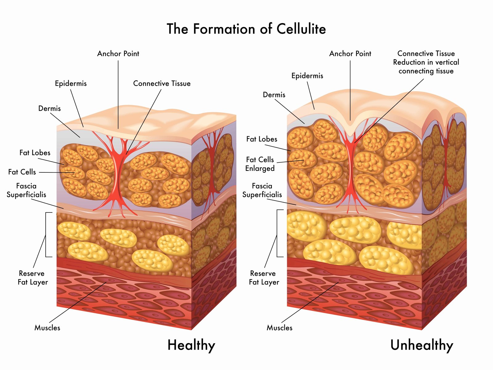 Getting Rid Of Cellulite:Do Massages Really Work? 1 Getting rid of cellulite