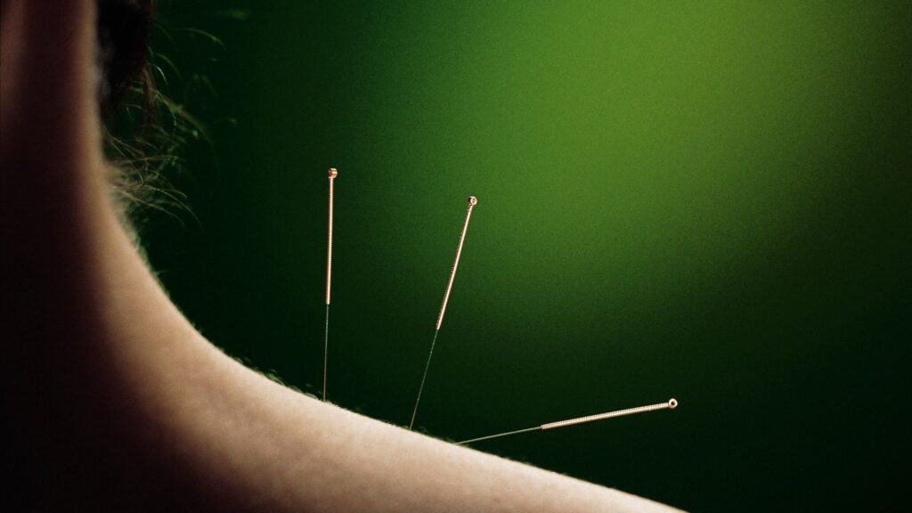 Acupuncture For Stress-What's The Science? 3 Acupuncture For Stress-What's The Science? 2