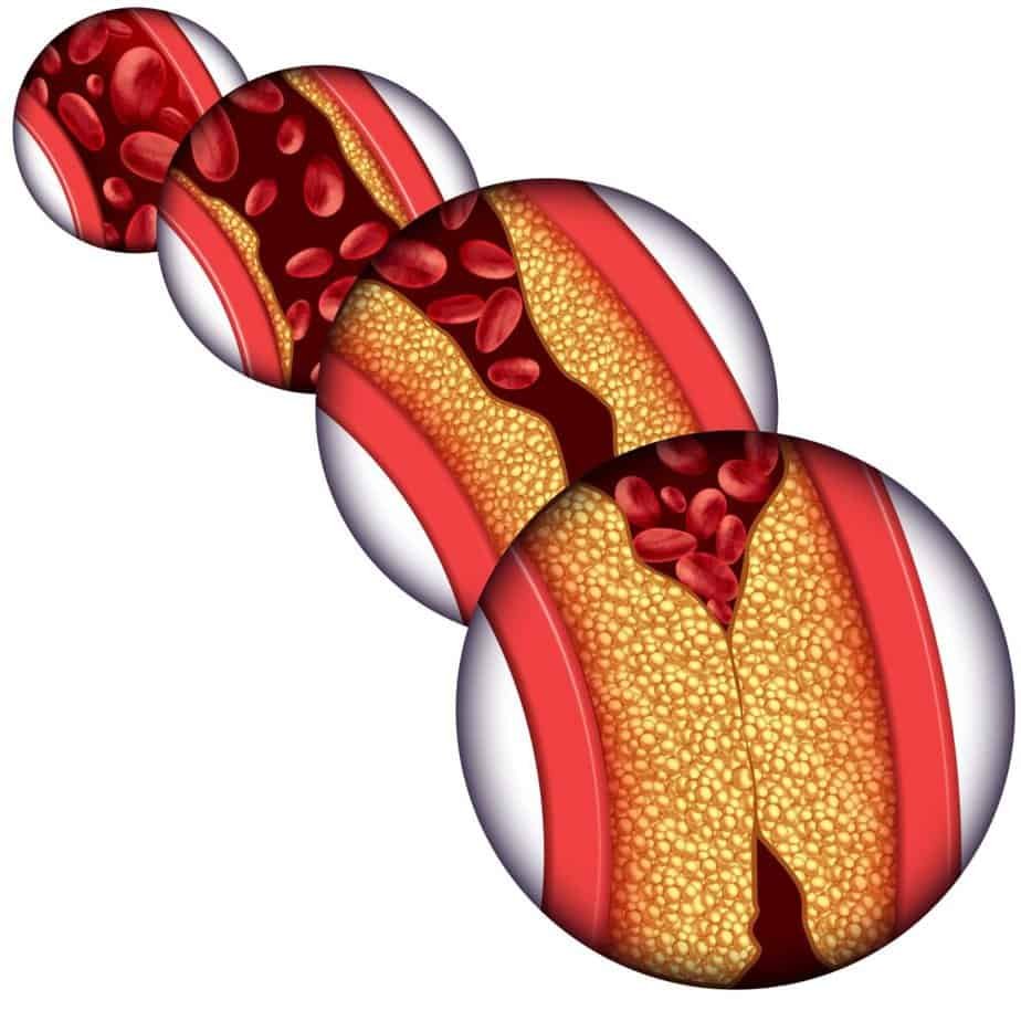 Artery disease coronary illness as a medical concept